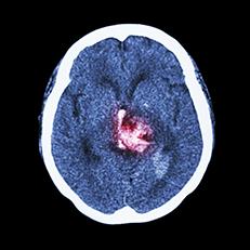 MRI of brain showing damage