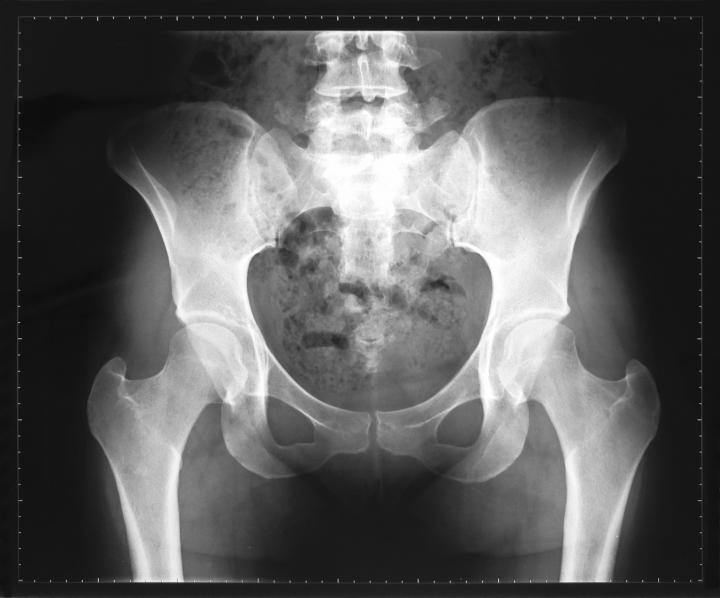 X-Ray image of hips
