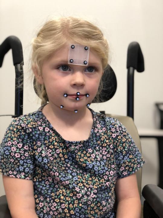 A little girl with blond hair is sitting in a wheelchair with little plastic dots taped above her eyes and around her mouth.
