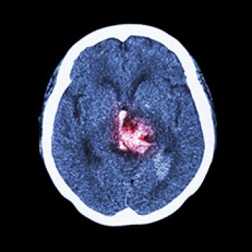 MRI of brain showing damage