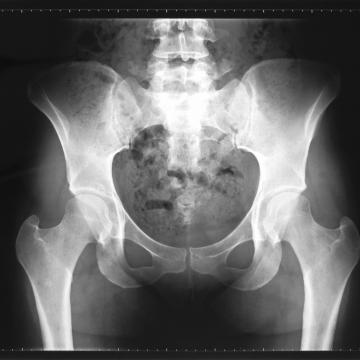 X-Ray image of hips