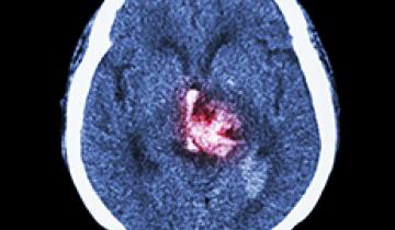 MRI of brain showing damage