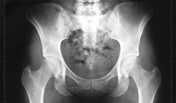 X-Ray image of hips