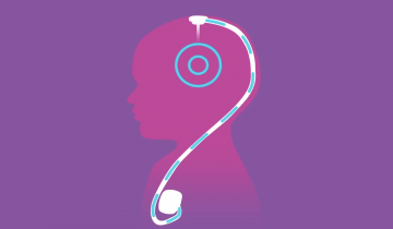 An illustration of a head and shoulders from the side view with a small catheter inserted in the top of the head with a line that goes down to a portal at the shoulder