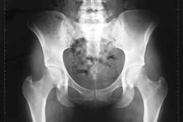 X-Ray image of hips