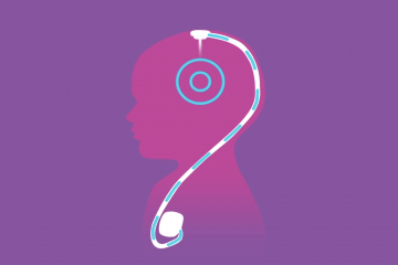 An illustration of a head and shoulders from the side view with a small catheter inserted in the top of the head with a line that goes down to a portal at the shoulder